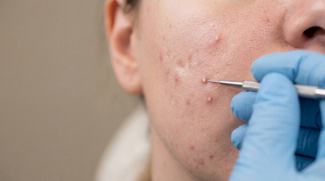 Cosmetologist performing professional acne treatment on young woman face. Dermatologist using comedone extractor tool to clear skin pores. Clinical procedure for problematic skin care.
