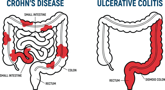 Crohn disease vs ulcerative colitis medical infographic vector illustration, inflammatory bowel anatomy