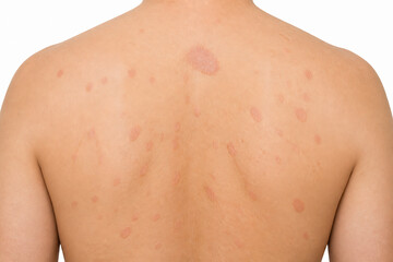 Naklejka premium A close-up of a person's bare back displaying numerous small, reddish skin blemishes.
