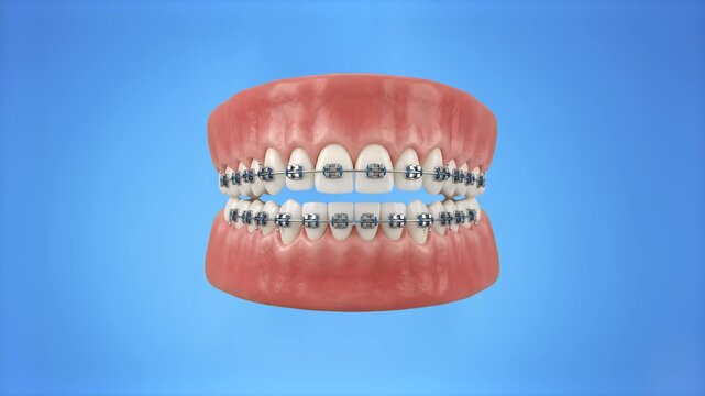 Detailed 3D model of upper and lower jaws with metallic dental braces hovering against a solid blue screen background. Perfect for stomatology advertisements, medical keying overlays, dental care prom