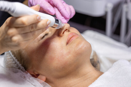 Professional hydradermabrasion treatment targeting the nose and T-zone using a vacuum facial device. Deep pore cleansing, exfoliation and skin rejuvenation performed by a cosmetologist.