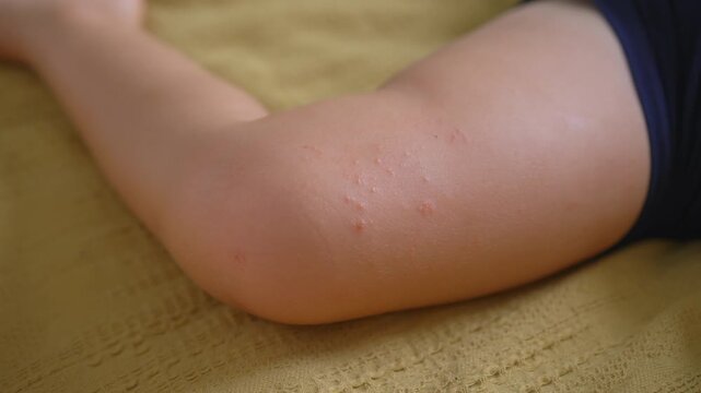 Red rash spots and small blisters near child knee. Close-up.