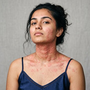 Close up portrait of a young South Asian woman with acute urticaria hives on neck