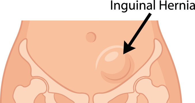  inguinal hernia medical condition on human abdomen illustration