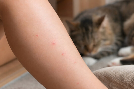 Close-up of red flea bites on woman's arm with blurred tabby cat sleeping in the background at home