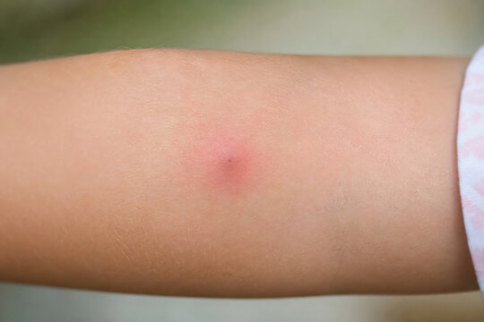 Close-up of a single swollen red mosquito bite on arm outdoors with green blurred background
