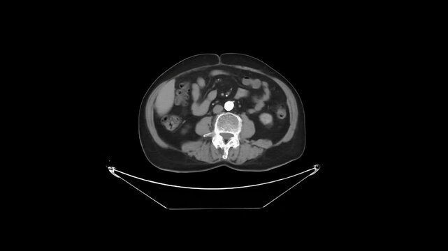 Contrast-Enhanced CT Abdomen and Pelvis Arterial Phase Axial 5 mm DICOM Medical Imaging Anatomy Loop