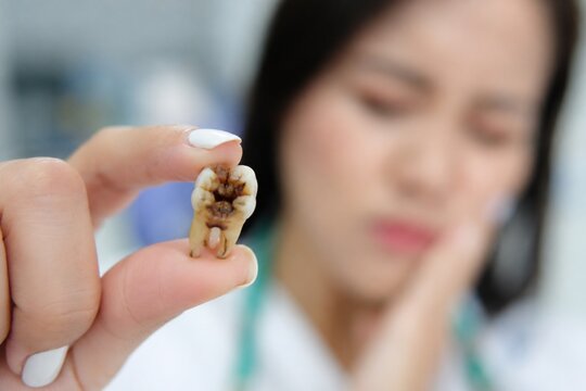 Close up of decayed extracted tooth held by patient