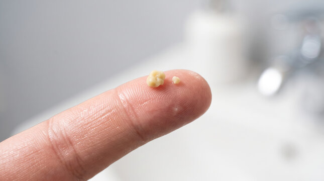指の上の膿栓・扁桃結石・臭い玉　口臭の原因となる扁桃の塊のクローズアップ