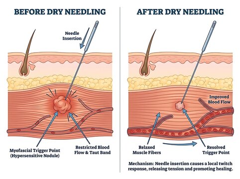 Dry needling procedure for muscle pain relief anatomy