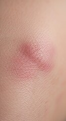 Fototapeta premium Close Up Red Bruise and Skin Irritation on Human Skin