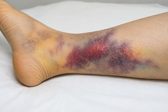 AI generated severe lower leg bruising purple yellow discoloration after trauma highlighting soft tissue injury healing recovery healthcare diagnosis medical education