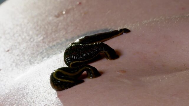 Medicinal Leeches Attached to Human Skin During Hirudotherapy Close Up