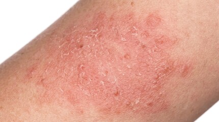 Fototapeta premium Close up of dry scaling skin with red rash caused by acute atopic dermatitis