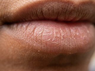 Fototapeta premium Dry chapped lip texture macro close up showing fine lines and cracks, conveying sense of dryness