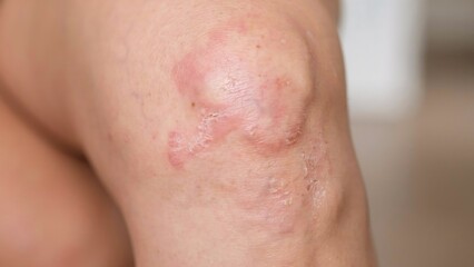 Fototapeta premium Close up of human skin rash and inflammation on person knee with inflammation