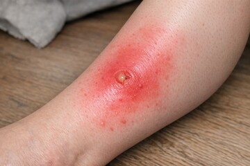 Fototapeta premium A person is shown with a wound on their leg