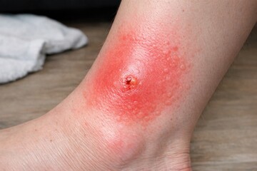 Fototapeta premium A close-up shot of a person's foot with a wound, suitable for medical or storytelling purposes