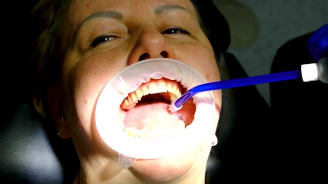 Dental implant crown placement using cheek retractor implant screwdriver and saliva ejector followed by patient smiling at beautiful treatment result in mirror