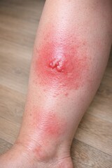 Fototapeta premium A close-up view of a person's leg showing a noticeable bruise