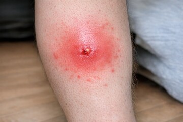 Fototapeta premium A close-up shot of a person's leg showing a red spot, possibly an injury or rash