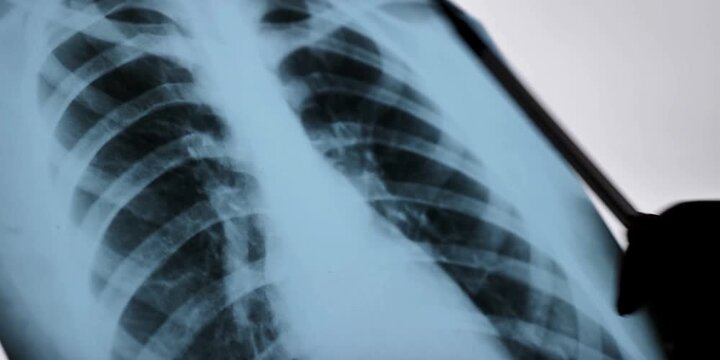 A radiologist examines a chest radiograph displaying the skeletal structure of the rib cage and lung field, representing medical imaging technology for diagnostic purposes
