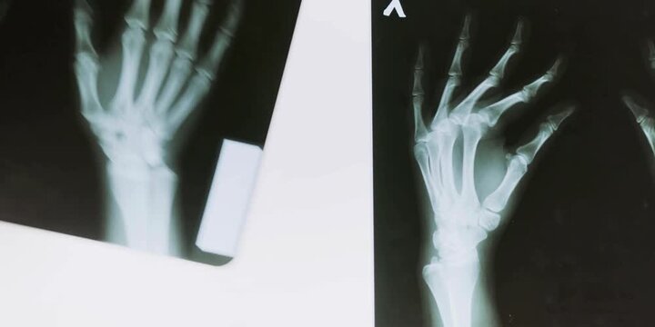 Radiographic images display the intricate skeletal structures of human hands, revealing bone composition and anatomical arrangements for medical diagnostic purposes in a clinical setting