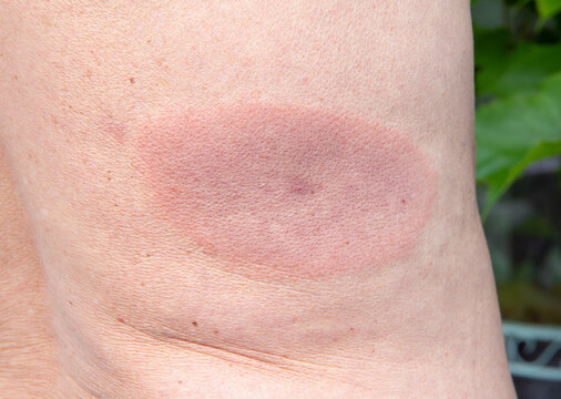 Lyme disease, also known as Lyme borreliosis, red rash patch on adult man back skin. Borreliosis is tick-borne disease. The rash was present for about a week before it was noticed and treatment.