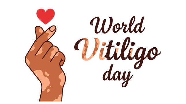 World Vitiligo Day vector illustration, showing a hand with vitiligo skin making a mini heart gesture, red heart icon, isolated on white background, for awareness campaigns and social media