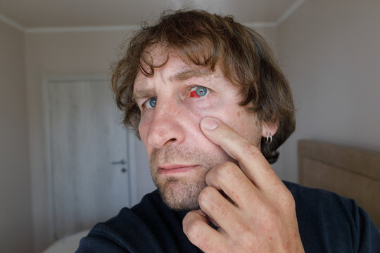  Eye hemorrhage