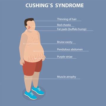 3D Isometric Flat Vector Illustration of Cushing Syndrome, Overproduction Of Cortisol By Body Results In CushingS Syndrome Leading To Various Health Issues.