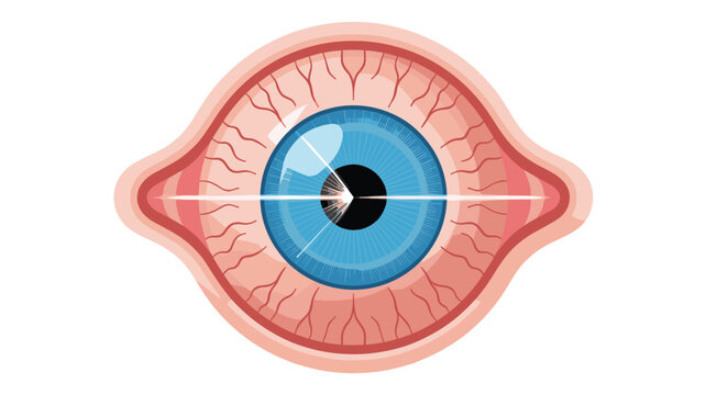Human eye illustration showing significant redness and irritation with visible blood vessels across the sclera on a white background.