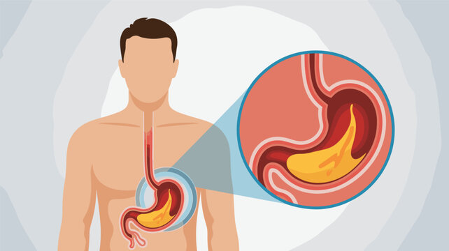 Human torso diagram showing stomach acid reflux and heartburn in the esophagus with a detailed circular view.