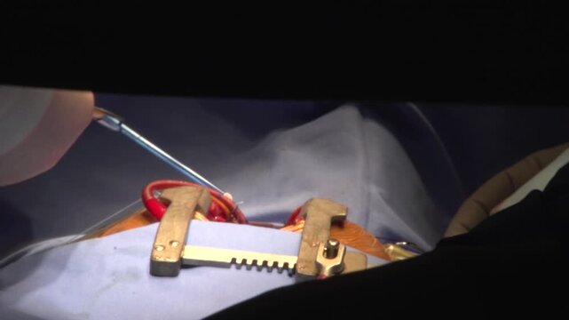 Close-up shot of a heavy metal sternal retractor holding open an incision site during a complex surgical procedure, with the silhouetted hands of a surgeon working under operating room lights.