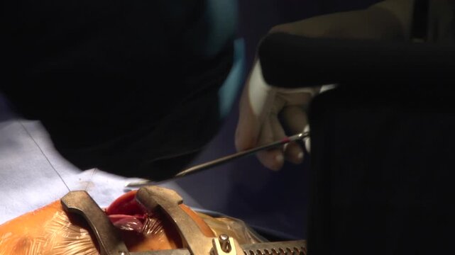 Extreme close-up shot of a surgeon wearing sterile gloves carefully manipulating tissue inside an open surgical incision site held by a metal retractor during a hospital operating procedure.