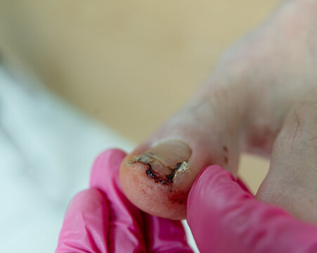 Closeup of a gloved hand holding an injured big toe with a wound and bloody cut. A concerned physician shows the painful toenail recovering from the injury in a sterile podiatry treatment room.