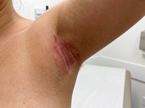 Intertrigo Pictures Showing Skin Fold Rash, Redness, Irritation, Moisture-Related Inflammation, Medical Reference, Healthcare Education, and Awareness