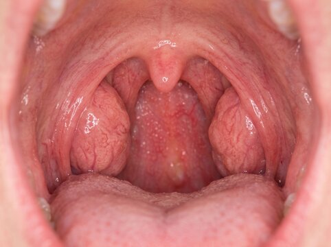 Picture of Tonsils Showing Healthy Throat Anatomy, Oral Cavity Structure, Medical Reference, Healthcare Education, and Clinical Awareness Information