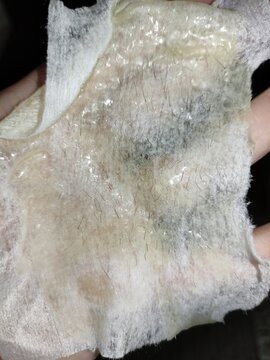 Used wet wipe with pulled out hair after sugaring hair removal procedure