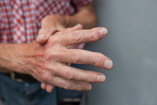 Close-up of elderly man holding his painful hand affected by arthritis or joint disease. Aging and chronic pain, physical discomfort, joint inflammation.