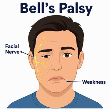 Bell's palsy facial nerve paralysis weakness illustration