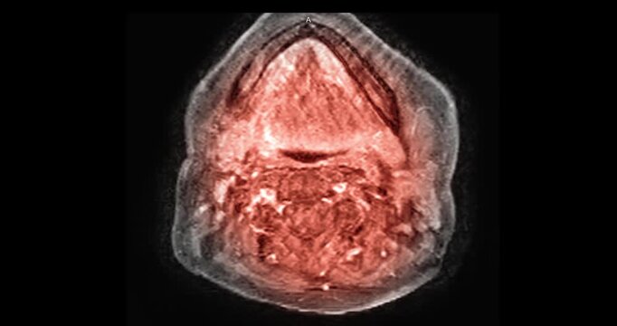 Magnetic resonance imaging sagittal scan of the human spine shown in three colour tones of magenta green and red blue on black background.