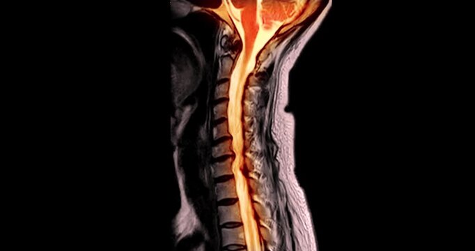 Grayscale MRI sagittal scan of the whole human body and spine displayed on a radiology PACS workstation interface medical software screen.