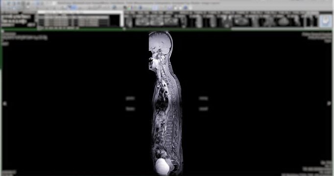 Colorized red and orange MRI coronal maximum intensity projection of the human cervical spine and neck rotating on black background.