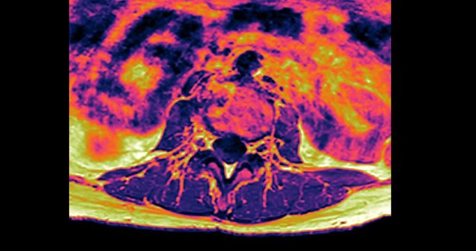 Fire toned colorized MRI coronal scan of the human cervical spine and neck glowing on black background dramatic medical animation.