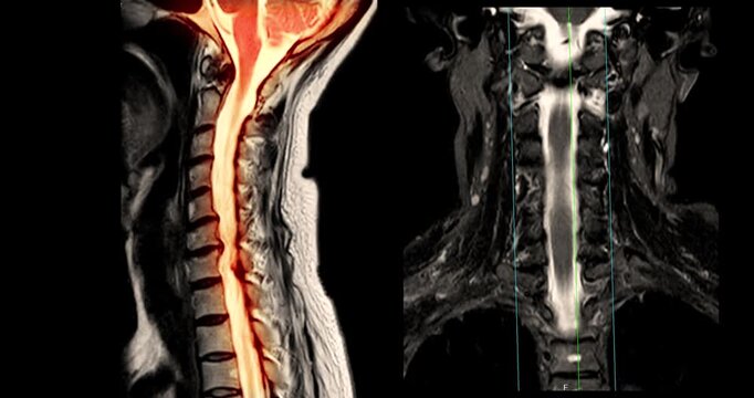 Colorized MRI axial cross section of the human lumbar spine and abdomen in vivid purple magenta and yellow tones on black background.