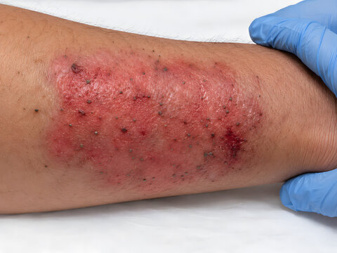 Medical professional examining a severe skin rash on a patient's arm, highlighting the redness, inflammation, and damaged skin texture requiring dermatological assessment and potential treatment