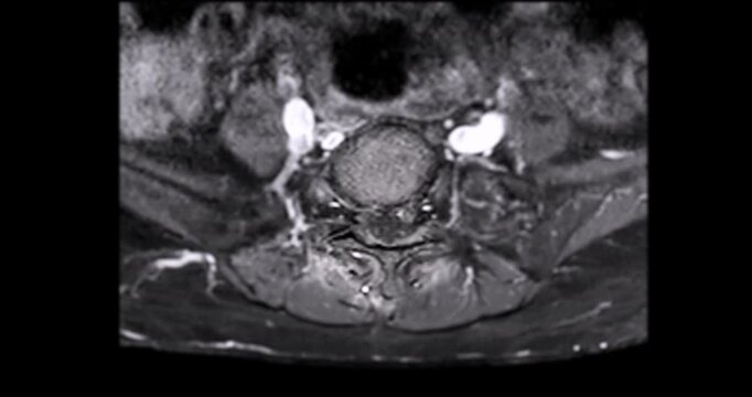 Colorized yellow purple and red MRI coronal scan of the human cervical spine and neck on black background vivid medical animation.