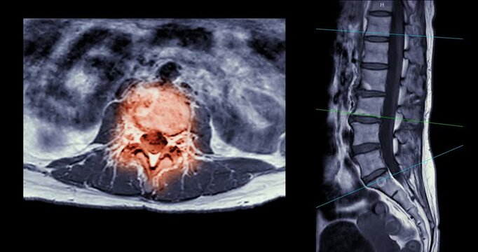 Grayscale magnetic resonance imaging axial cross section and sagittal view of the human lumbar spine on black background.