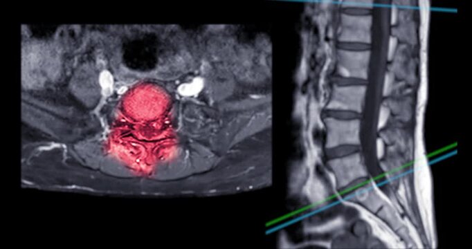 Colorized red MRI axial cross section of the human lumbar spine with a grayscale sagittal reference image on black background.